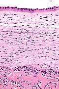 Image result for Chorioamnionitis