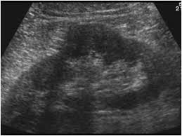 The incidence of this normal anatomic variant is estimated to be about 0.5%. Urinary Tract And Male Reproductive System 2 1 Kidney And Ureter Case 2 1 2 Benign Ren Diagnostic Medical Sonography Medical Ultrasound Vascular Ultrasound