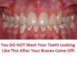 Teeth color would be different for different people. How To Whiten Teeth With Braces On 2 Of The Best Solutions