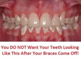 But how can you make sure to get all the hiding spots? How To Whiten Teeth With Braces On 2 Of The Best Solutions