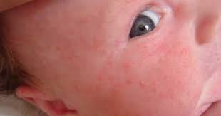 Yaitu bagaimana membaca dan menyebutkan tahun dalam bahasa inggris. Bintik Merah Pada Kulit Bayi 1 Tahun Berbagai Tahun