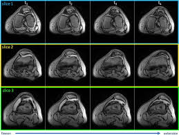 Image result for Patella Tracking Assessment