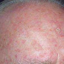 Skin cancer is one of the most common types of cancer. Skin Cancer On Scalp Prevention Tips For Bald Men Scary Symptoms