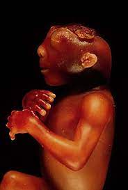 In case of anencephaly or anencephalic baby, the brain of the child does not possess skull, cranium, meninges, brain hemisphere and cerebellum. Anencephaly Wikipedia