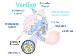 Labyrinthitis symptoms include ear pain or earache, dizziness, nausea, vomiting, vertigo, and tinnitus. Vertigo Imbalance Dizziness Synergex Physical Therapy