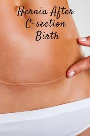 Hernia After C Section Birth Everything You Need To Know Hernia Symptoms Abdominal Hernia Abdominal Surgery