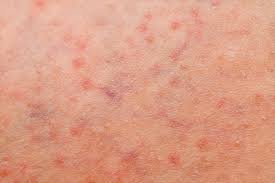 They can be small or large, itchy or hard spots that don't itch. What Is Folliculitis And How Is It Treated
