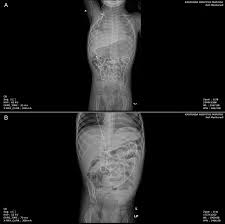 Shunt Malfunction In Patients With Hydrocephalus Complications Revisited Bmj Case Reports