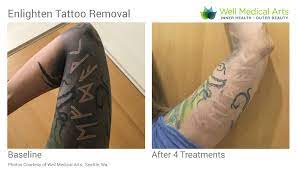 The removal process requires time and patience to ensure both safety and efficacy. Pin On Tattoo Removal
