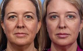 The truth is, unless you have before and after pictures to compare; Under Eye Rejuvenation Photos Rejuvent