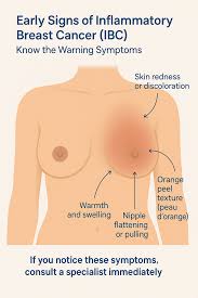 Image result for Inflammatory breast cancer