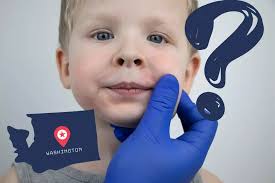 Parvovirus B19, Slapped Cheek Syndrome, On Rise in Washington