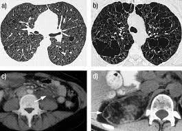 Lymphangioleiomyomatosis European Respiratory Society