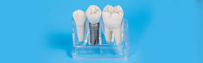 Exploring the Benefits of Dental Implants for a Confident Smile | blog