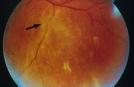 Image result for HIV Retinitis