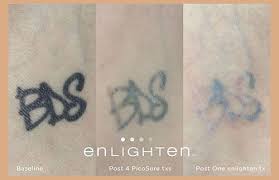 Fast acting tattoo fading gel. Laser Tattoo Removal Arkansas Laser And Skin Care