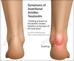 Signs And Symptoms Of Insertional Achilles Tendonitis Achilles Tendonitis Insertional Achilles Tendonitis Achilles Tendonitis Treatment