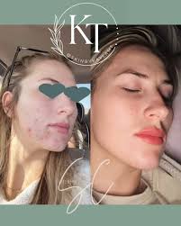 Skin by me 🙋🏼‍♀️, Lips by @thejacksoninjector 💋 , This is what trusting  us with your skin and having a consistent homecare regimen will give you! ,  We love clear, happy, HEALTHY skin. , 🥼come see us! ...