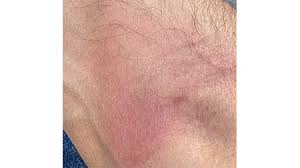 Image result for erysipel photos)