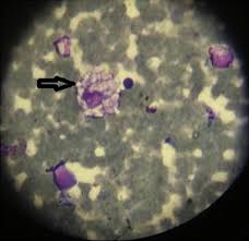 This disease is part of a group of disorders that cause bone and joint deformity as well as interference with normal growth. Prenatal Onset Niemann Pick Type C Disease With Nonimmune Hydrops Fetalis Pediatrics Neonatology