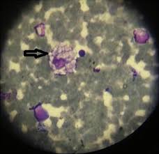 A, b, c1 and c2. Prenatal Onset Niemann Pick Type C Disease With Nonimmune Hydrops Fetalis Pediatrics Neonatology