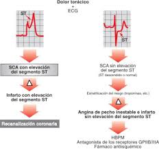 Infarto agudo al miocardio karen kortright maldonado. Infarto Agudo De Miocardio Con Elevacion Del Segmento St Primeras 48 Horas Sciencedirect