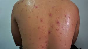 It spreads through coughs and sneezes. Ini Cara Cepat Obati Cacar Air Pada Orang Dewasa