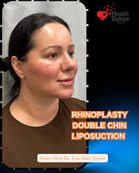 Natural Neck Rejuvenation with Double Chin Liposuction by Dr. Ferhat Ilen