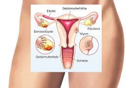 Myome An Der Gebarmutter Alles Uber Symptome Und Therapie Minimed At