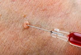 How long does hpv survive outside the body. Types Of Warts Symptoms Removal And Treatment