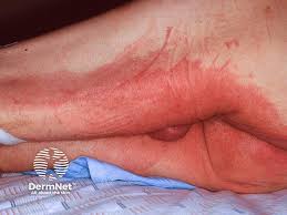 Image result for itchy skin rectum