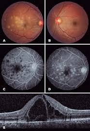 Apmppe abbreviation stands for acute posterior multifocal placoid pigment epitheliopathy. Scielo Brasil Unilateral Acute Posterior Multifocal Placoid Pigment Epitheliopathy In A Patient With A Strongly Positive Purified Protein Derivative Test Unilateral Acute Posterior Multifocal Placoid Pigment Epitheliopathy In A Patient