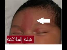 مع وضع خطوط حمراء، لا يتجاوزها طلابك.تجنب استخدام العقاب الانتقامي. ÙˆØ­Ù…Ø© ÙÙŠ Ø±Ø§Ø³ Ø§Ù„Ø·ÙÙ„ Ù‚Ø¨Ù„Ø© Ø§Ù„Ù…Ù„Ø§Ø¦ÙƒØ© Youtube