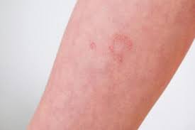 Image result for dermatitis contacta children