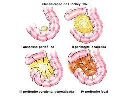 By clasificaciónde on jul 5, 2017 1,220 0. Doenca Diverticular Dos Colons Ppt Carregar