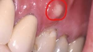 Image result for Periodontal Abscess