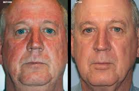 While rosacea may make some patients want to tear their proverbial hair out, a recent small study discovered a potential association between the disorder and a form of progressive hair loss in women. Rosacea Treatment In Bellingham Burlington Washington