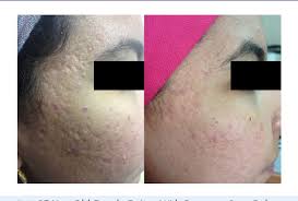 Maybe you would like to learn more about one of these? Figure 1 From Ablative Fractional 10 600 Nm Carbon Dioxide Laser Versus Non Ablative Fractional 1540 Nm Erbium Glass Laser In Egyptian Post Acne Scar Patients Semantic Scholar