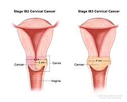 Guidelines for the management rec13.2: Cervical Cancer Treatment Pdq Treatment Patient Information Nci Michigan Medicine