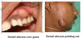 Root canal treatment is a dental procedure that replaces a tooth's damaged or infected pulp with a filling. Root Canal Therapy R C T Oralhealth In