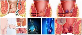 La hinchazón de los pies y los tobillos es una situación relativamente común, que suele estar asociada a una mala circulación sanguínea. Trombosis Hemorroidal Sintomas Causas Riesgos Tratamientos Y Contraindicaciones Arriba Salud