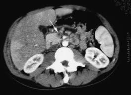 Thrombose Veineuse Mesenterico Porte Aigue Associee A Une Septicemie A Fusobacterium Necrophorum Sciencedirect