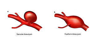 A brain aneurysm is a weak spot in a blood vessel that bulges and fills with blood. Brain Aneurysms Baylor Medicine
