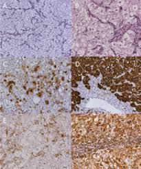 The mean survival rate of spinal cancer is up to 40% when treatments are instituted. Chordoma Encyclopedia Article Citizendium
