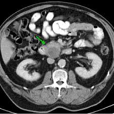 Of these, benign tumors in the pleura are most common. Histologic Findings Of Benign Multicystic Mesothelioma Of The Pancreas Download Scientific Diagram