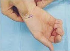 Image result for Fall on Outstretched Hand