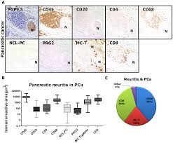 Pancreatic cancer is the 11th most common cancer in the uk. Plos One Perineural Mast Cells Are Specifically Enriched In Pancreatic Neuritis And Neuropathic Pain In Pancreatic Cancer And Chronic Pancreatitis