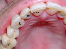 Image result for Occlusal