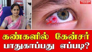 Cancer often has no specific symptoms, so it is important that people limit their risk factors and undergo appropriate cancer screening. à®•à®£ à®•à®³ à®² à®• à®© à®šà®° à®ª à®¤ à®• à®ª à®ªà®¤ à®Žà®ª à®ªà®Ÿ Eye Cancer Symptoms In Tamil Dr Kalpana Tower News Youtube