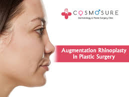 Augmentation Rhinoplasty In Plastic Surgery Cosmosure Clinic
